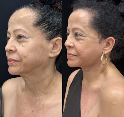 Deep Plane Facelift Before & After Gallery - Patient 712300 - Image 2