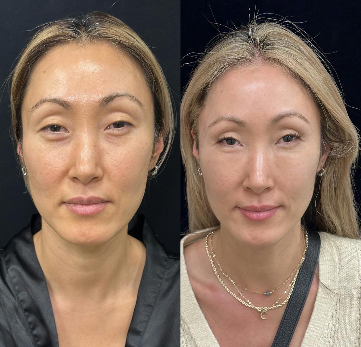  Facial Fat Transfer Before & After Gallery - Patient 252434 - Image 1