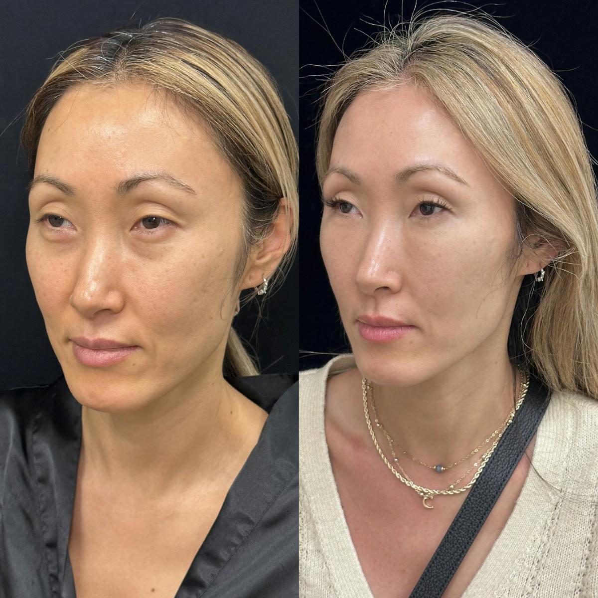  Facial Fat Transfer Before & After Gallery - Patient 252434 - Image 3