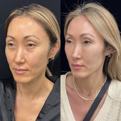 Facial Fat Transfer Before & After Gallery - Patient 252434 - Image 3