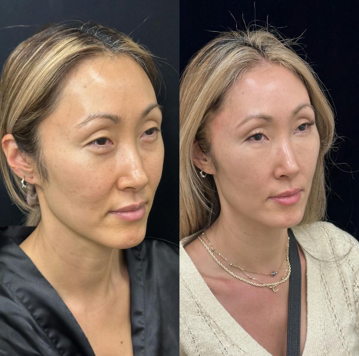 Facial Fat Transfer Before & After Gallery - Patient 252434 - Image 2