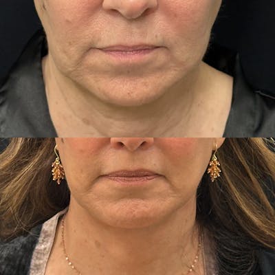 Lip Lift Before & After Gallery - Patient 290369 - Image 1