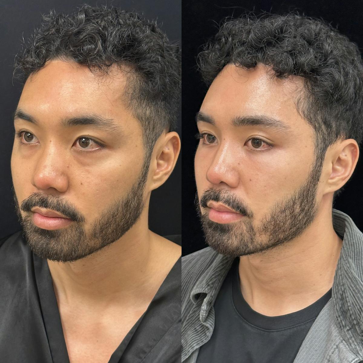 Lower Blepharoplasty Before & After Gallery - Patient 115050 - Image 3