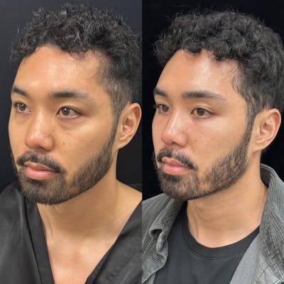 Lower Blepharoplasty Before & After Gallery - Patient 115050 - Image 3