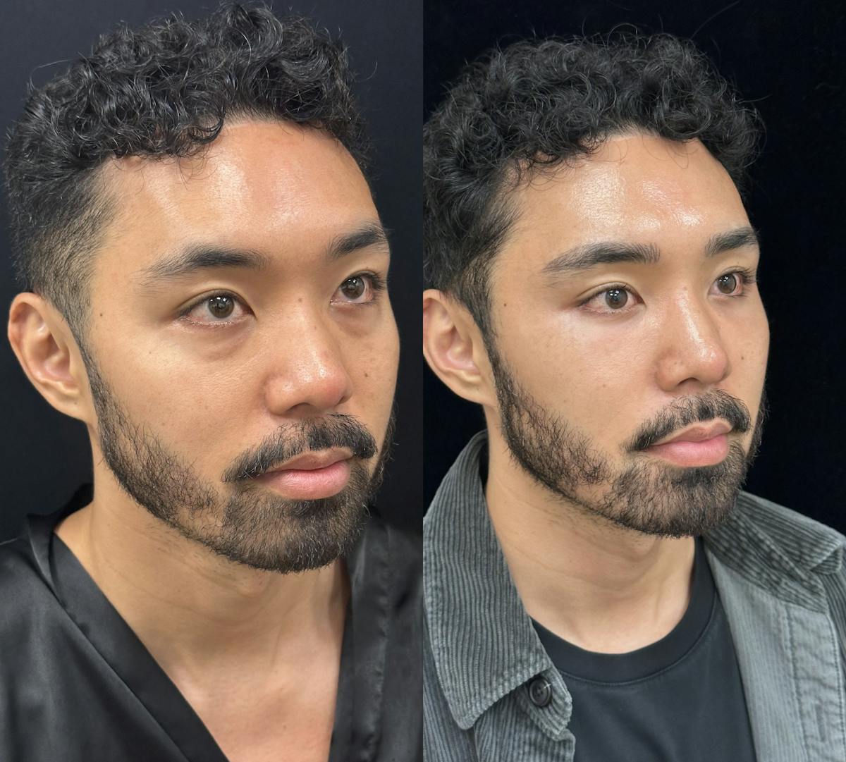 Lower Blepharoplasty Before & After Gallery - Patient 115050 - Image 2