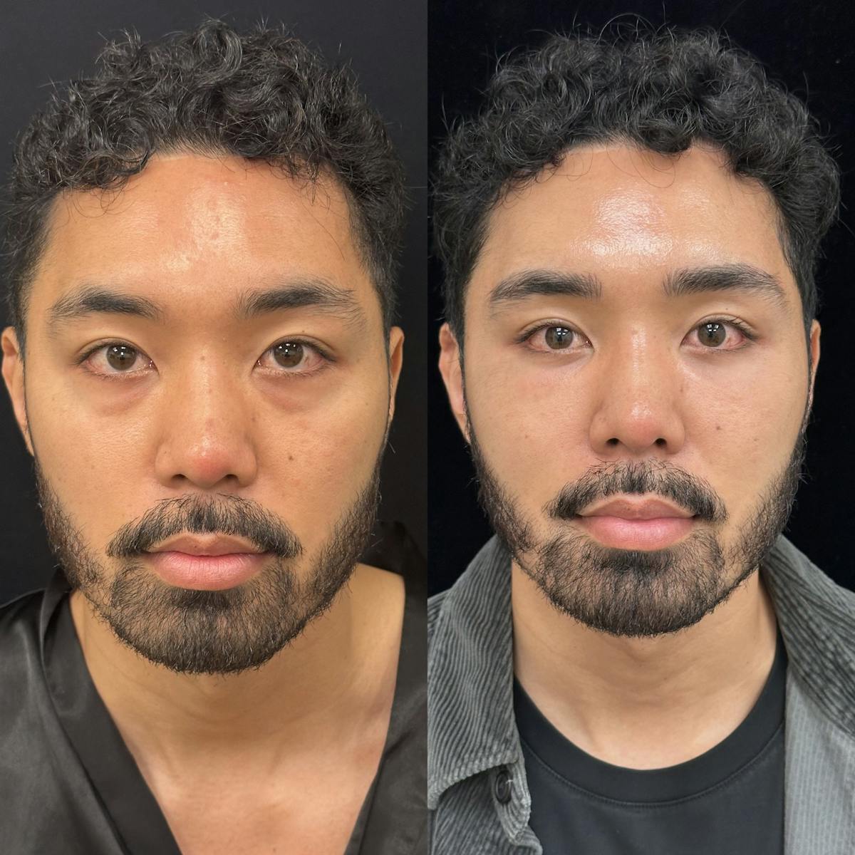 Lower Blepharoplasty Before & After Gallery - Patient 115050 - Image 1