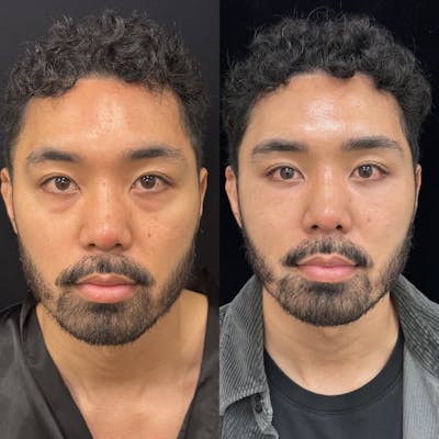 Lower Blepharoplasty Before & After Gallery - Patient 115050 - Image 1