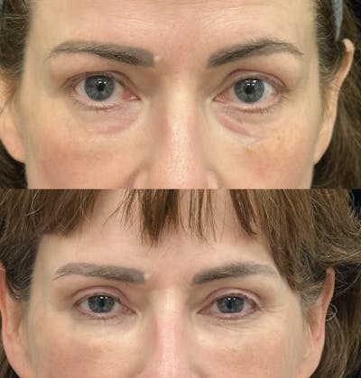 Lower Blepharoplasty Before & After Gallery - Patient 138036 - Image 1