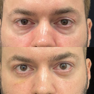 Lower Blepharoplasty Before & After Gallery - Patient 314088 - Image 1