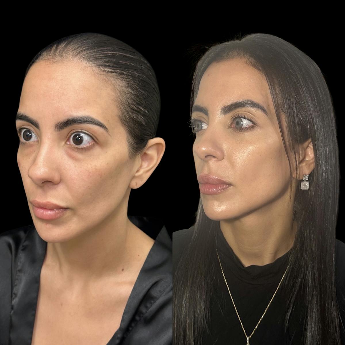 Lower Blepharoplasty Before & After Gallery - Patient 377758 - Image 2