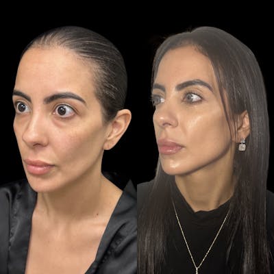 Lower Blepharoplasty Before & After Gallery - Patient 377758 - Image 2