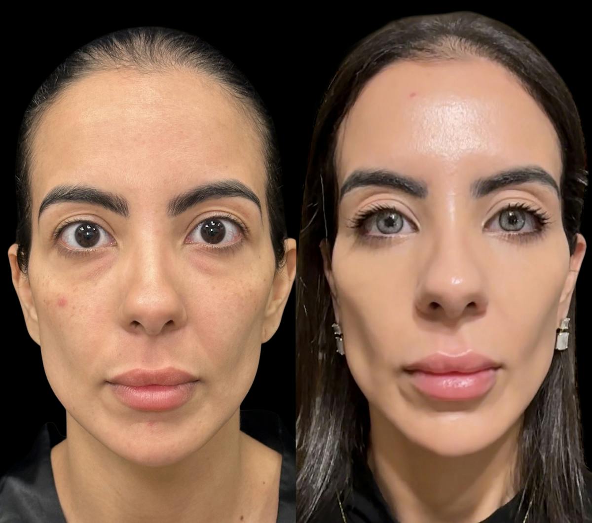 Lower Blepharoplasty Before & After Gallery - Patient 377758 - Image 1