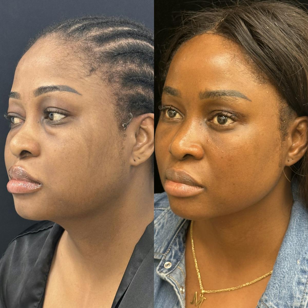 Lower Blepharoplasty Before & After Gallery - Patient 354325 - Image 2