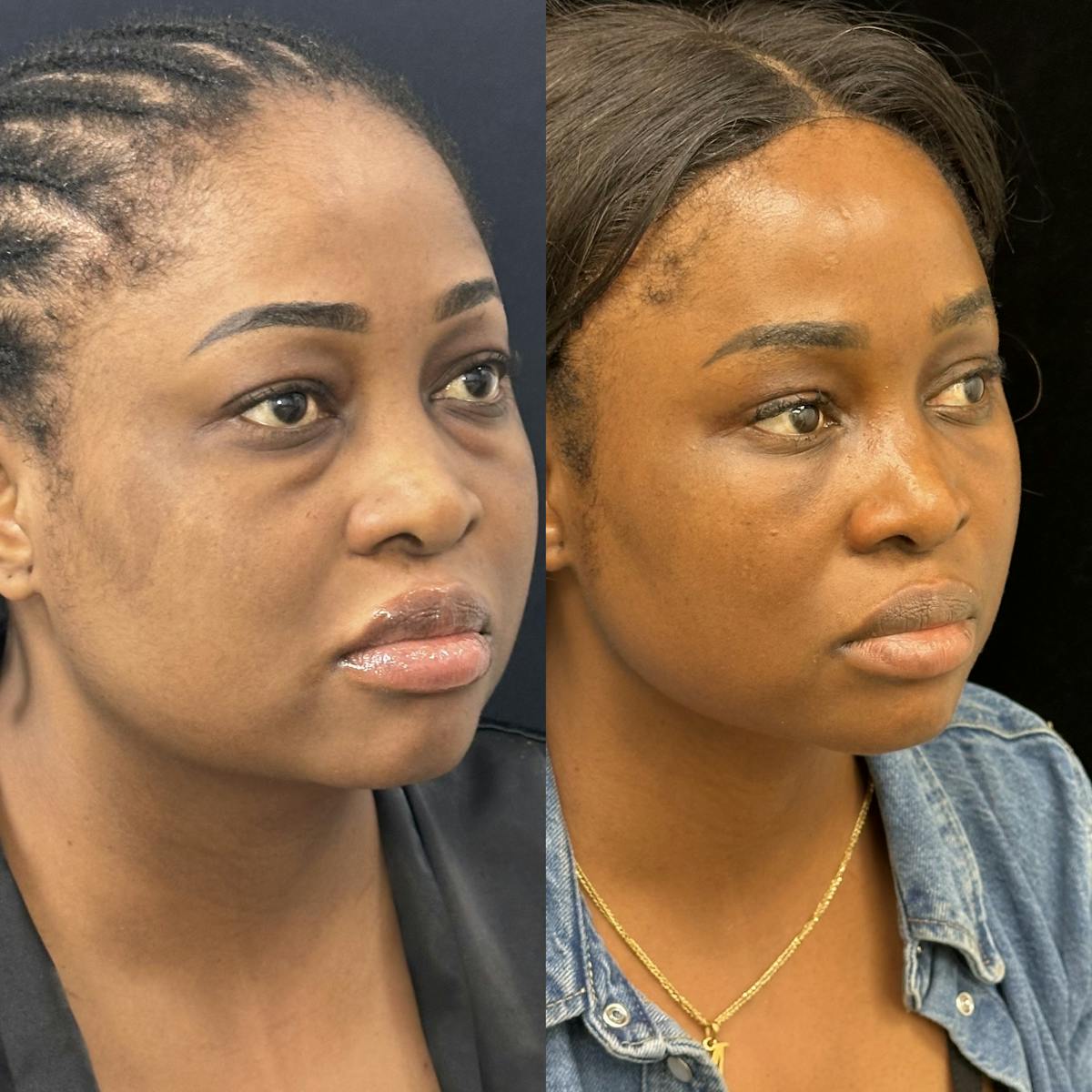 Lower Blepharoplasty Before & After Gallery - Patient 354325 - Image 3