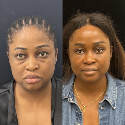 Lower Blepharoplasty Before & After Gallery - Patient 354325 - Image 1