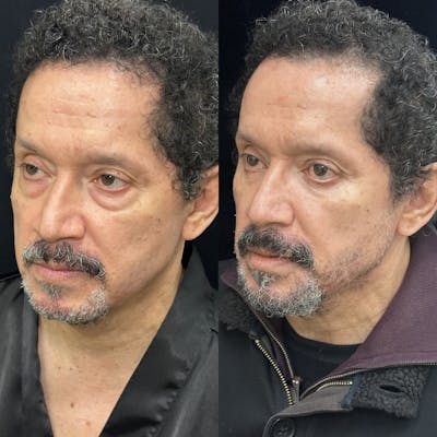 Lower Blepharoplasty Before & After Gallery - Patient 443474 - Image 2