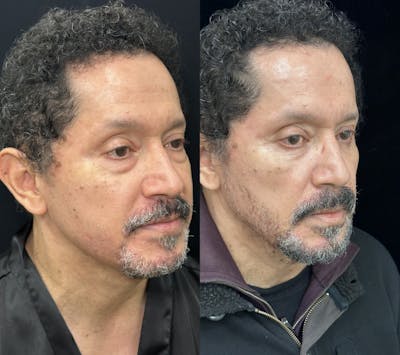 Lower Blepharoplasty Before & After Gallery - Patient 443474 - Image 3