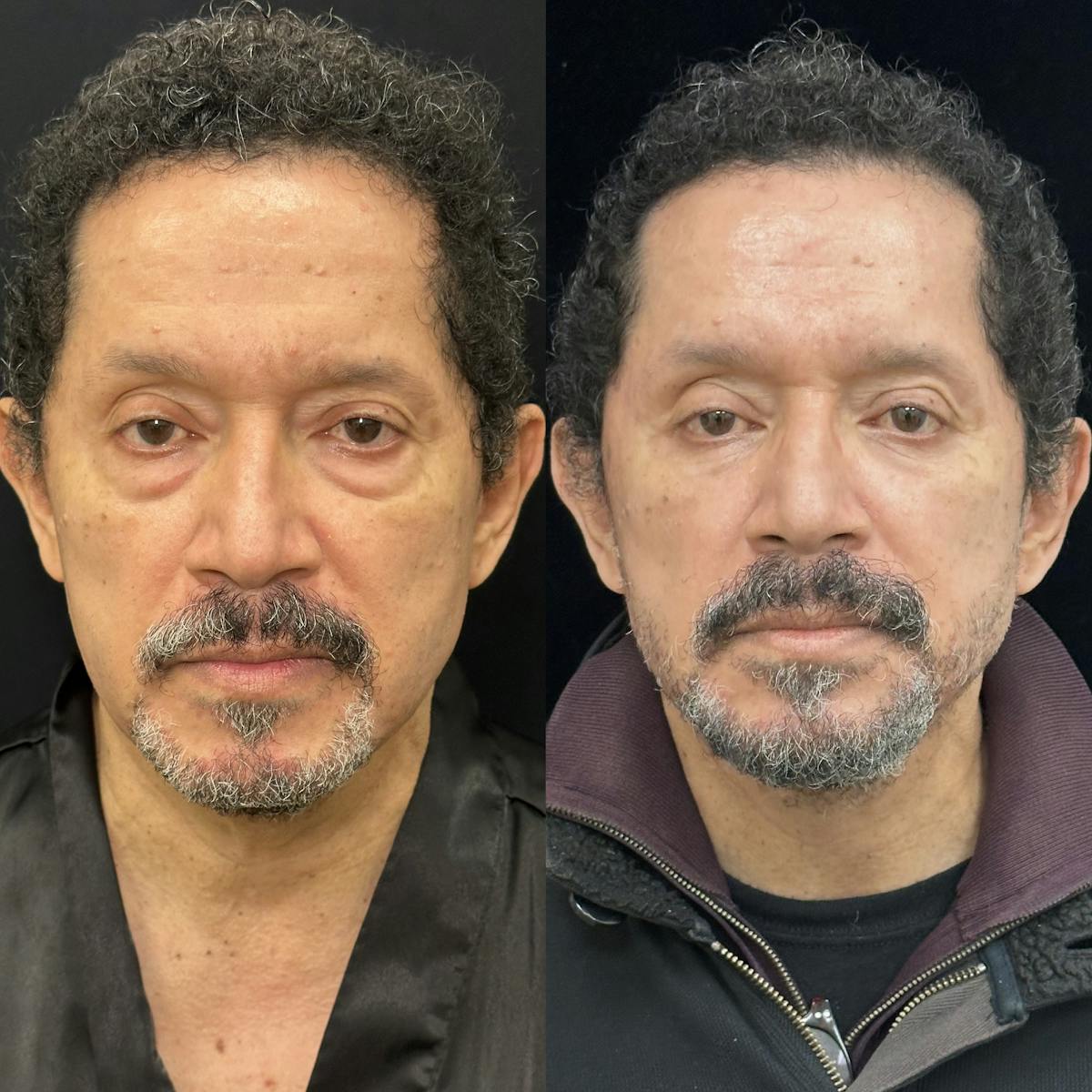 Lower Blepharoplasty Before & After Gallery - Patient 443474 - Image 1