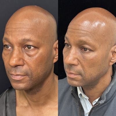 Lower Blepharoplasty Before & After Gallery - Patient 389349 - Image 2