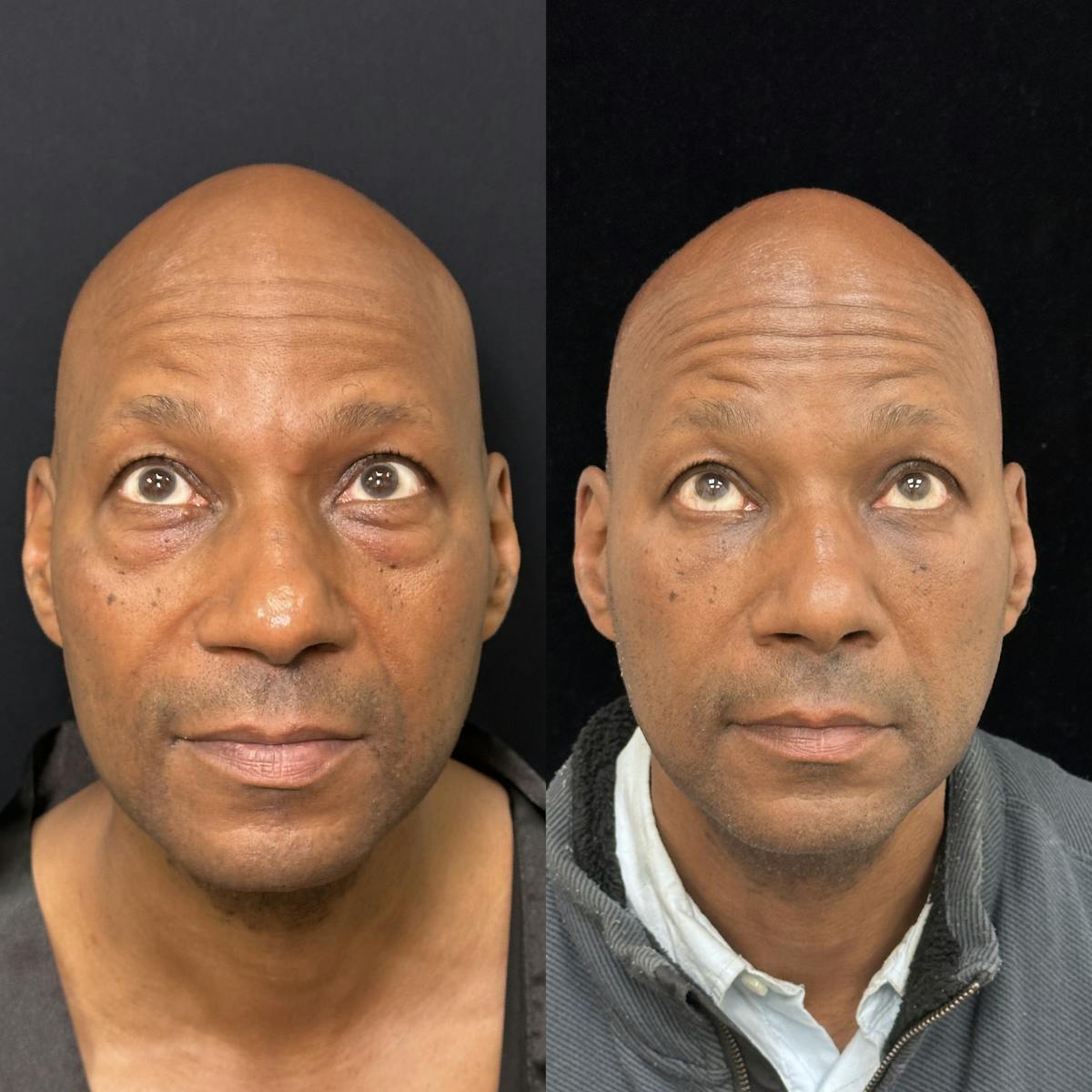 Lower Blepharoplasty Before & After Gallery - Patient 389349 - Image 3