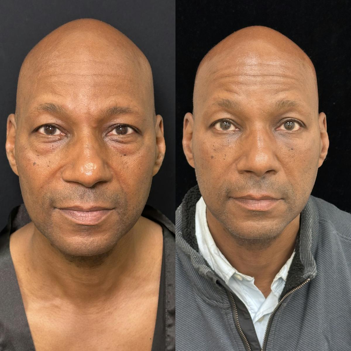 Lower Blepharoplasty Before & After Gallery - Patient 389349 - Image 1
