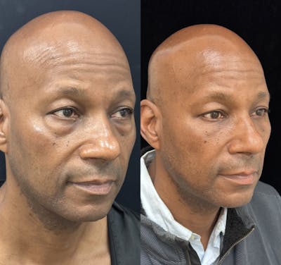 Lower Blepharoplasty Before & After Gallery - Patient 389349 - Image 4