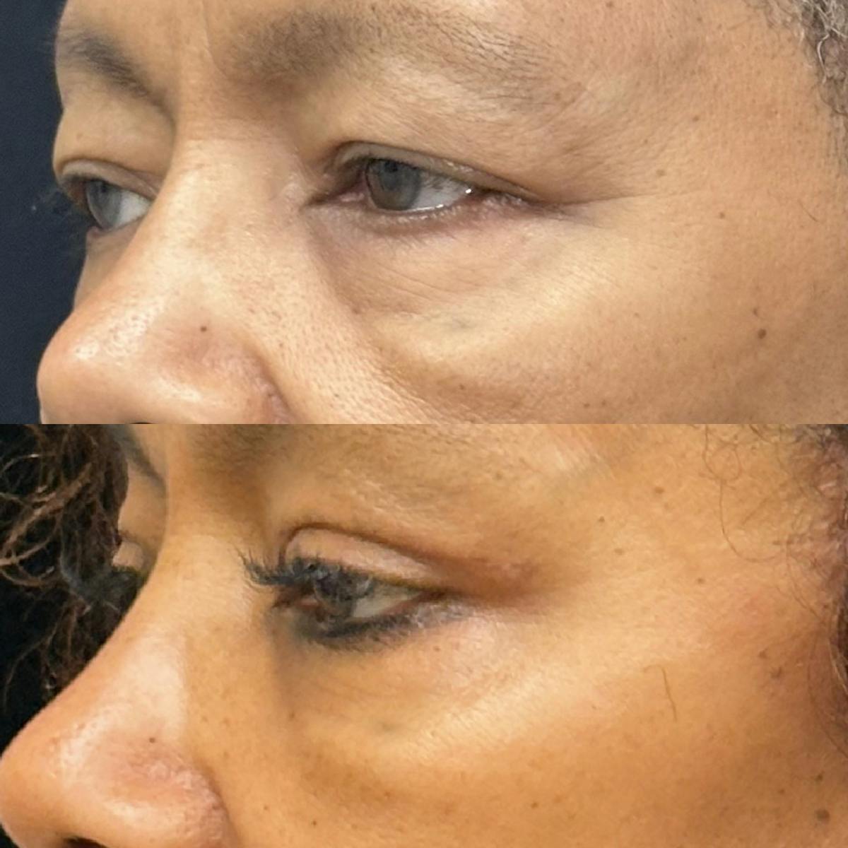  Upper Blepharoplasty Before & After Gallery - Patient 335196 - Image 3