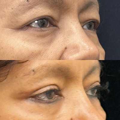 Upper Blepharoplasty Before & After Gallery - Patient 335196 - Image 2