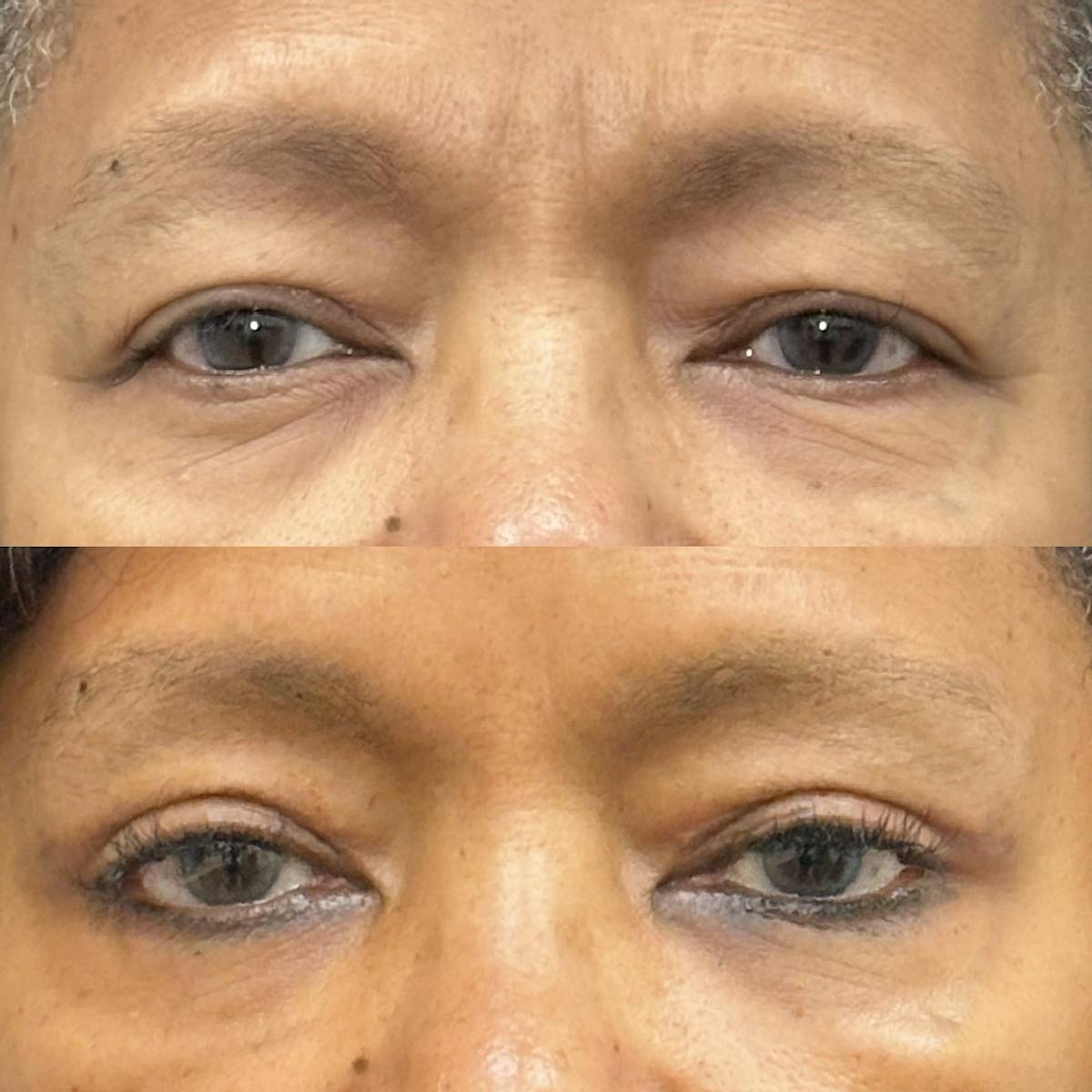  Upper Blepharoplasty Before & After Gallery - Patient 335196 - Image 1