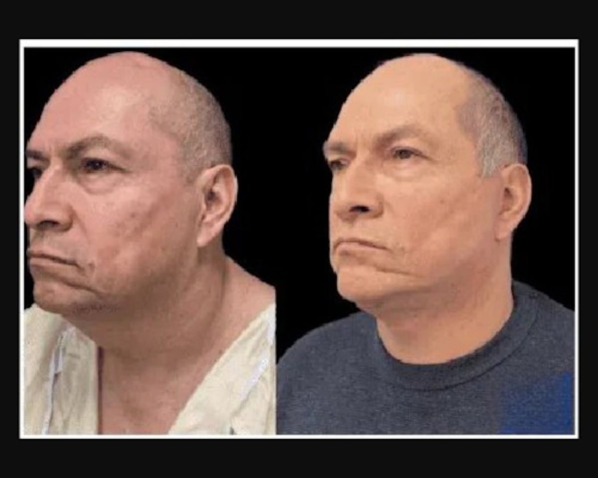 Deep Plane Facelift Before & After Gallery - Patient 307347 - Image 1