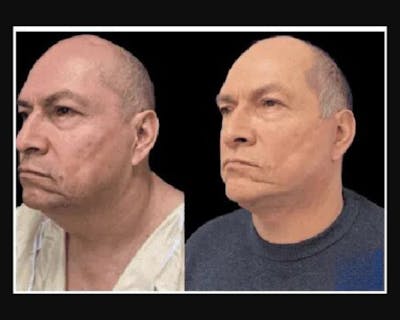 Deep Plane Facelift Before & After Gallery - Patient 307347 - Image 1