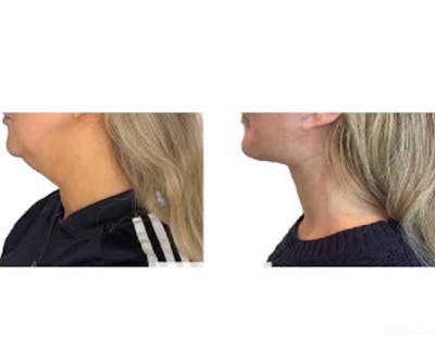 Deep Plane Facelift Before & After Gallery - Patient 360877 - Image 2