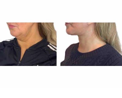 Deep Plane Facelift Before & After Gallery - Patient 360877 - Image 3