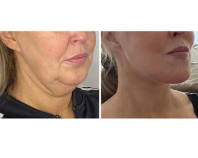 Deep Plane Facelift Before & After Gallery - Patient 360877 - Image 4
