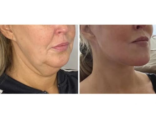 Deep Plane Facelift Before & After Gallery - Patient 360877 - Image 4