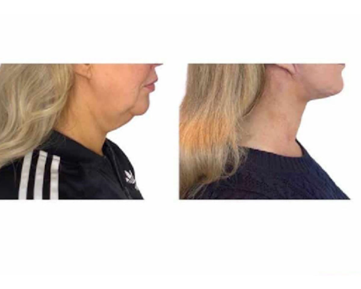 Deep Plane Facelift Before & After Gallery - Patient 360877 - Image 1