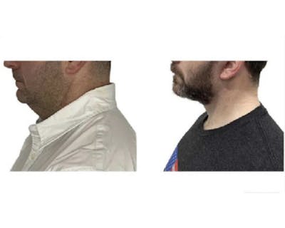 Deep Plane Facelift Before & After Gallery - Patient 252535 - Image 1