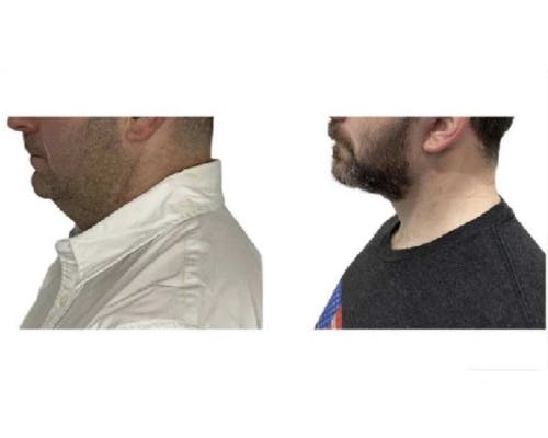 Deep Plane Facelift Before & After Gallery - Patient 252535 - Image 1