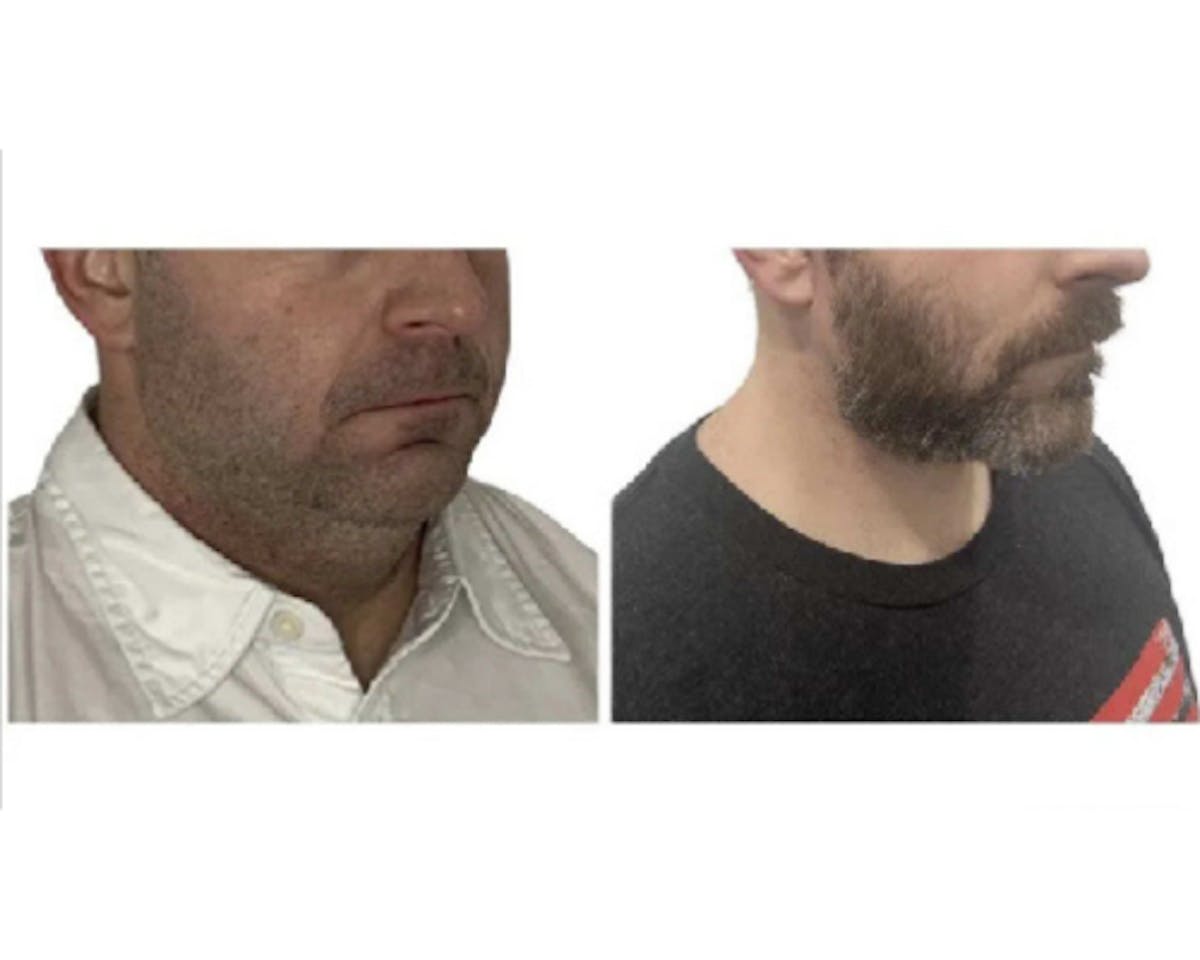 Deep Plane Facelift Before & After Gallery - Patient 252535 - Image 2