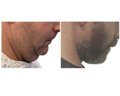 Deep Plane Facelift Before & After Gallery - Patient 252535 - Image 3