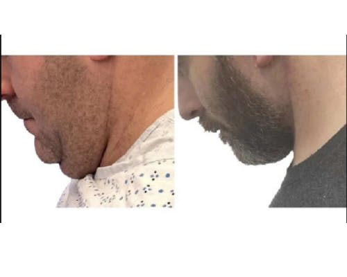 Deep Plane Facelift Before & After Gallery - Patient 252535 - Image 4
