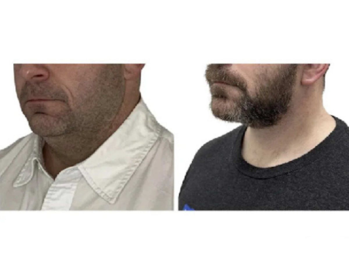 Deep Plane Facelift Before & After Gallery - Patient 252535 - Image 5