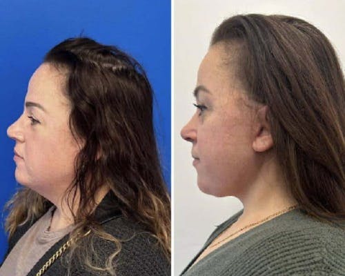 Deep Plane Facelift Before & After Gallery - Patient 229835 - Image 1