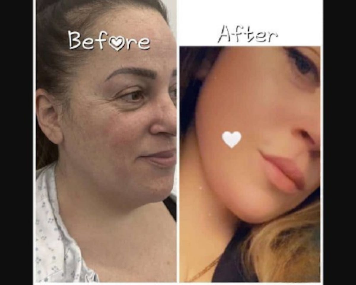 Deep Plane Facelift Before & After Gallery - Patient 229835 - Image 2