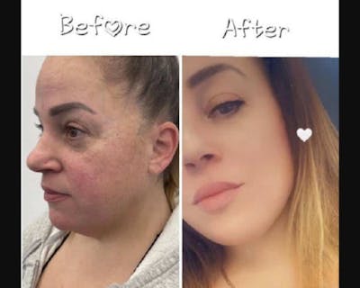 Deep Plane Facelift Before & After Gallery - Patient 229835 - Image 3