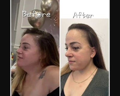 Deep Plane Facelift Before & After Gallery - Patient 229835 - Image 4