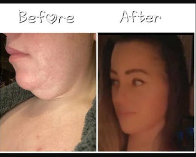 Deep Plane Facelift Before & After Gallery - Patient 229835 - Image 5