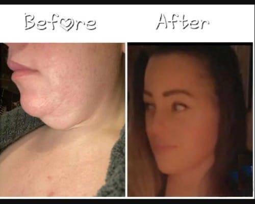 Deep Plane Facelift Before & After Gallery - Patient 229835 - Image 5
