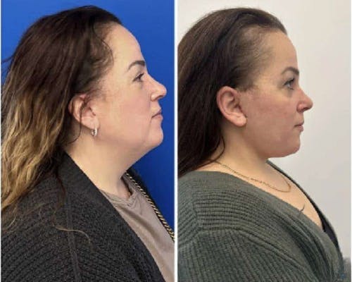 Deep Plane Facelift Before & After Gallery - Patient 229835 - Image 6