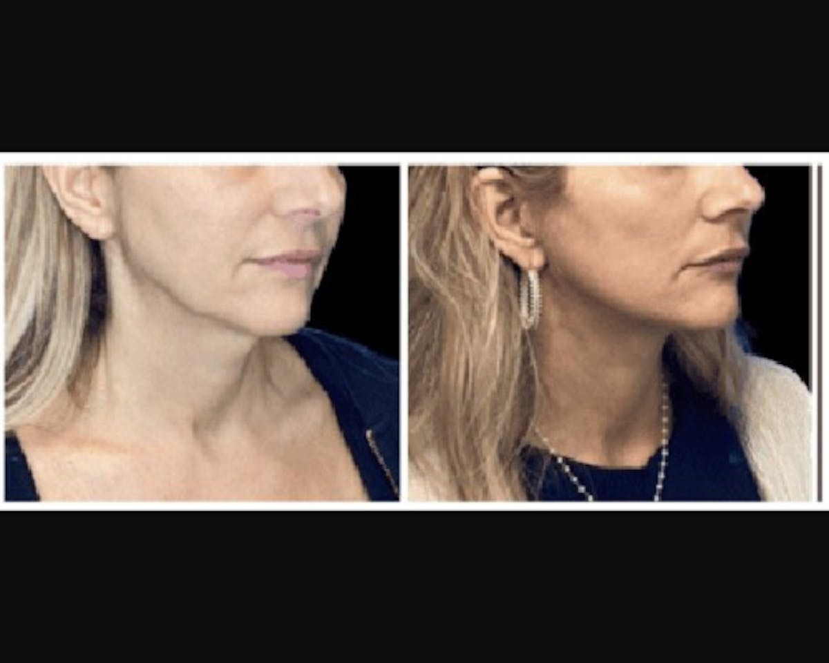 Deep Plane Facelift Before & After Gallery - Patient 427571 - Image 1